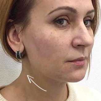 Обличчя після процедур